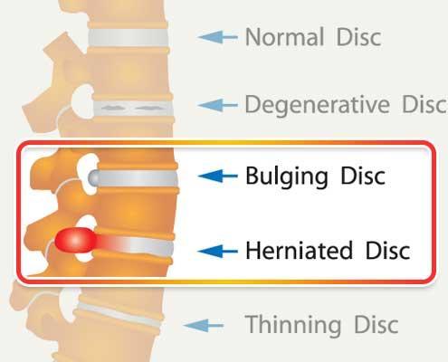 Bulging Disk vs. Herniated Disk