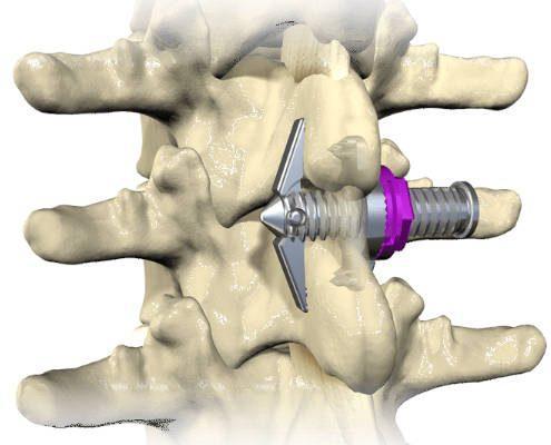 Patient Success Story with Spinal Simplicity’s Minuteman Procedure